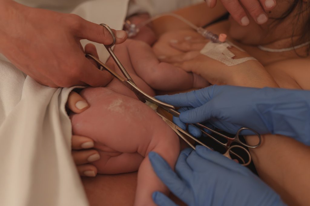 Umbilical cord being clamped after birth, birth photography in Arnhem